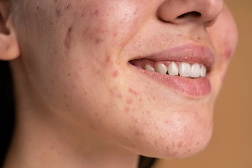 Best Ingredients for Acne-Prone Skin commonly used in skincare products for oily and blemish-prone skin