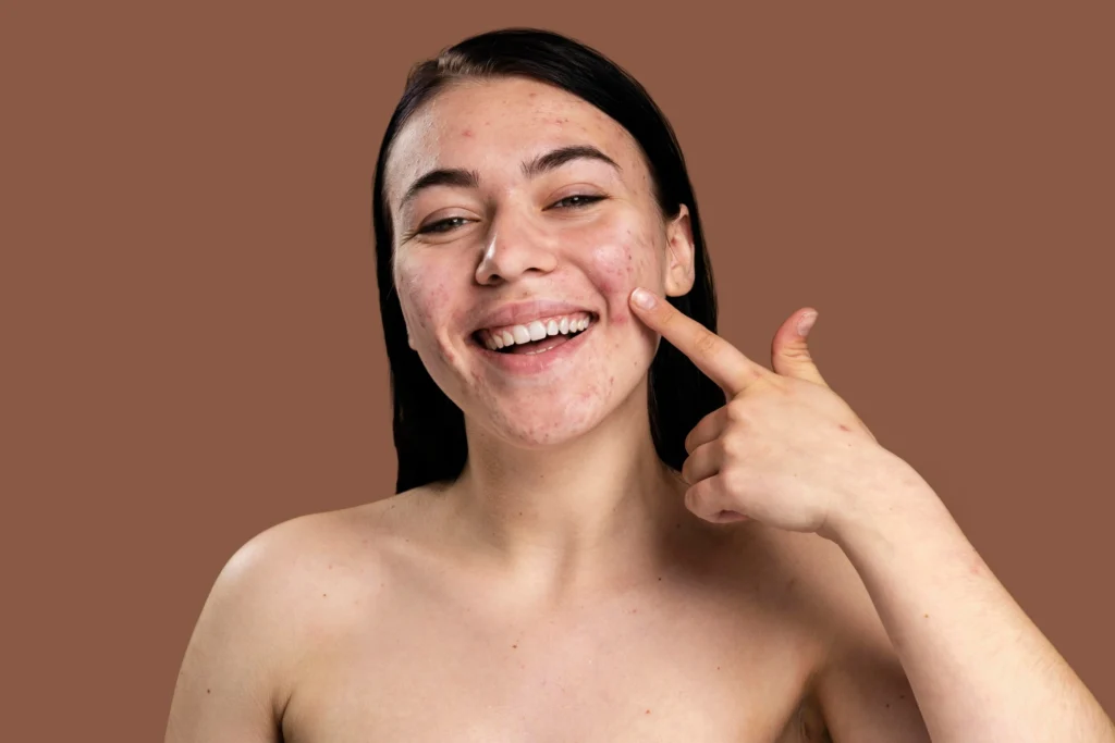 Daily skincare routine featuring Ingredients for Acne-Prone Skin to maintain balanced and healthy-looking skin