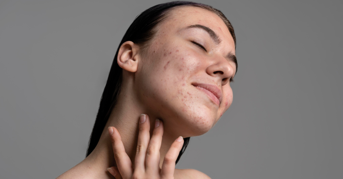 Natural remedies for dull skin in summer to restore healthy glow